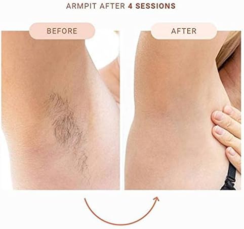 IPL Laser Hair Removal